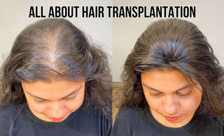 Hair Transplantation - Yay or Nay?