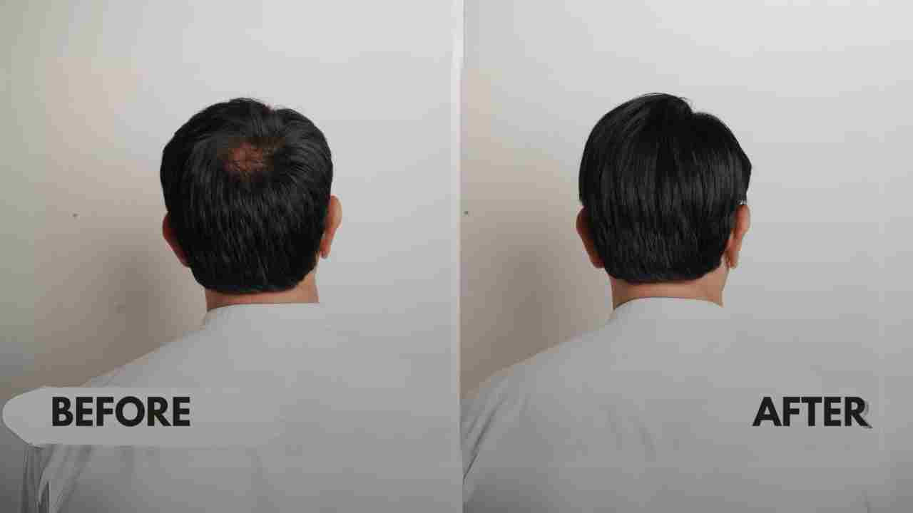 Hair Toppers for Men: A Solution to Hair Loss