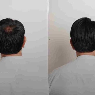 Hair Toppers for Men: A Solution to Hair Loss